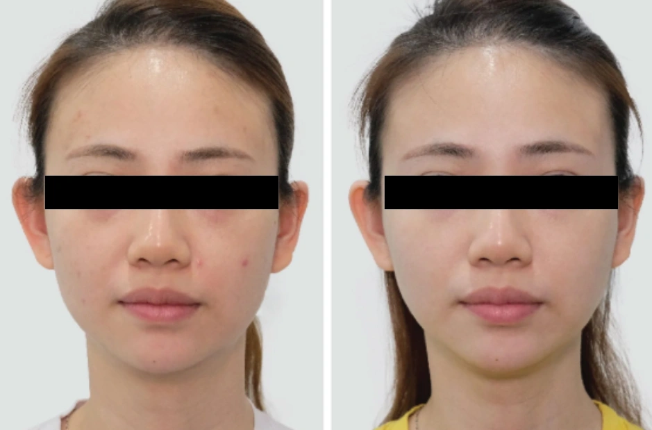 Restylane Vital Light before and after improved skin hydration, smoother texture and refreshed appearance