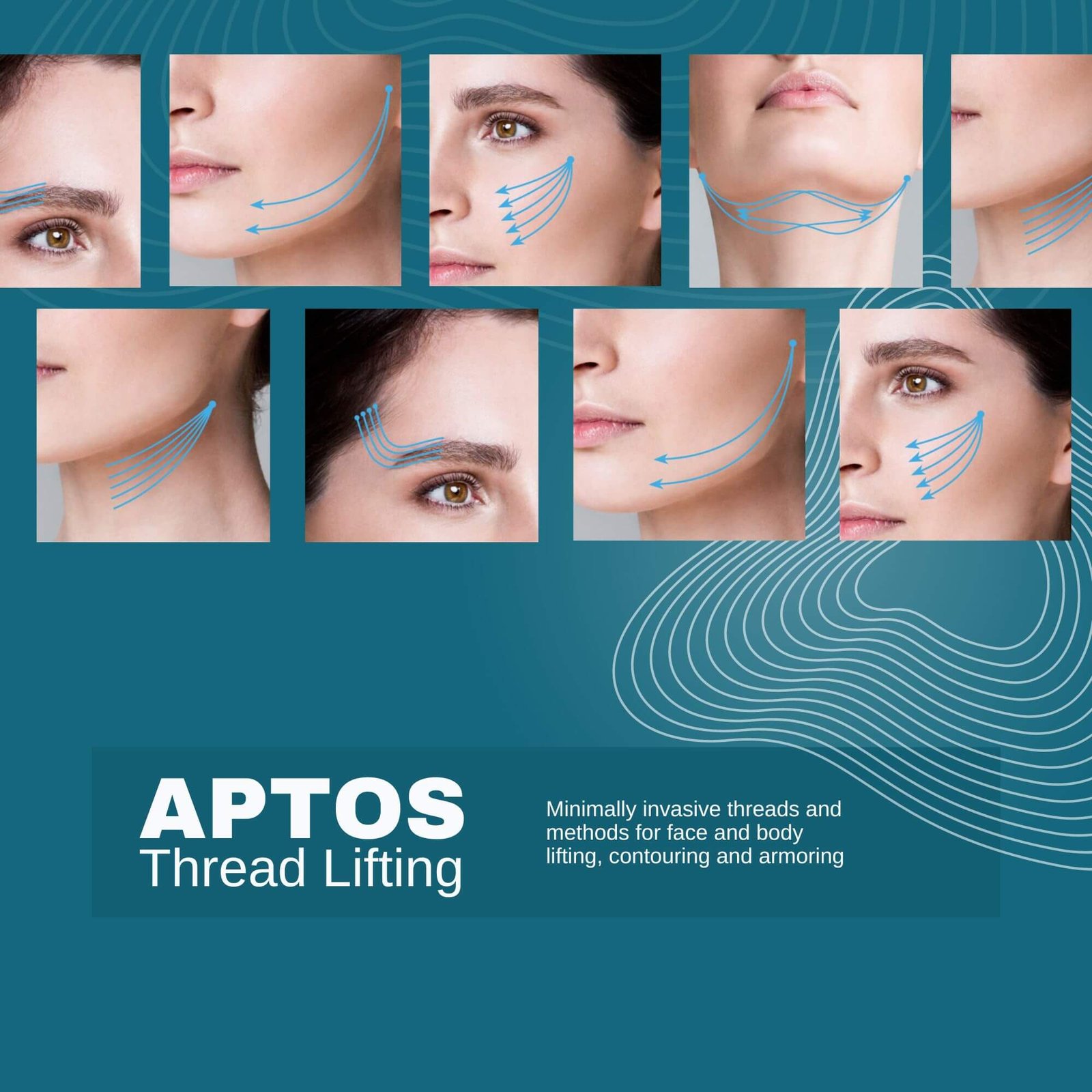 Doctor-led Aptos Thread Lift treatment at The Ritz Clinic