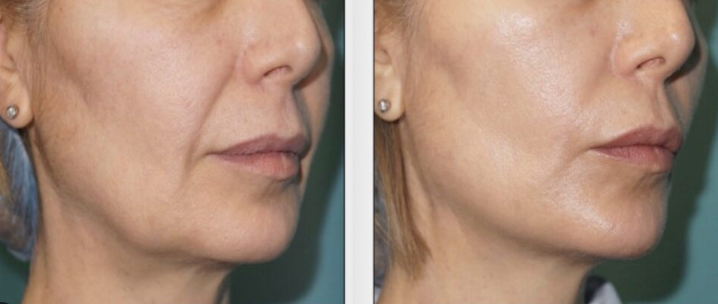 Aptos Thread before and after improved facial contour, jawline definition and lifting effect