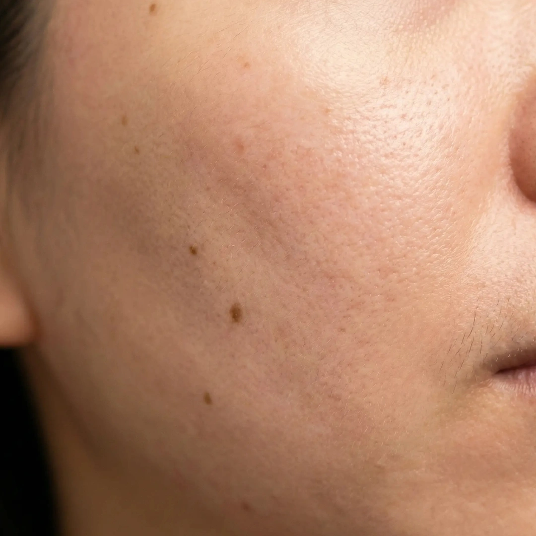 Collagen stimulation