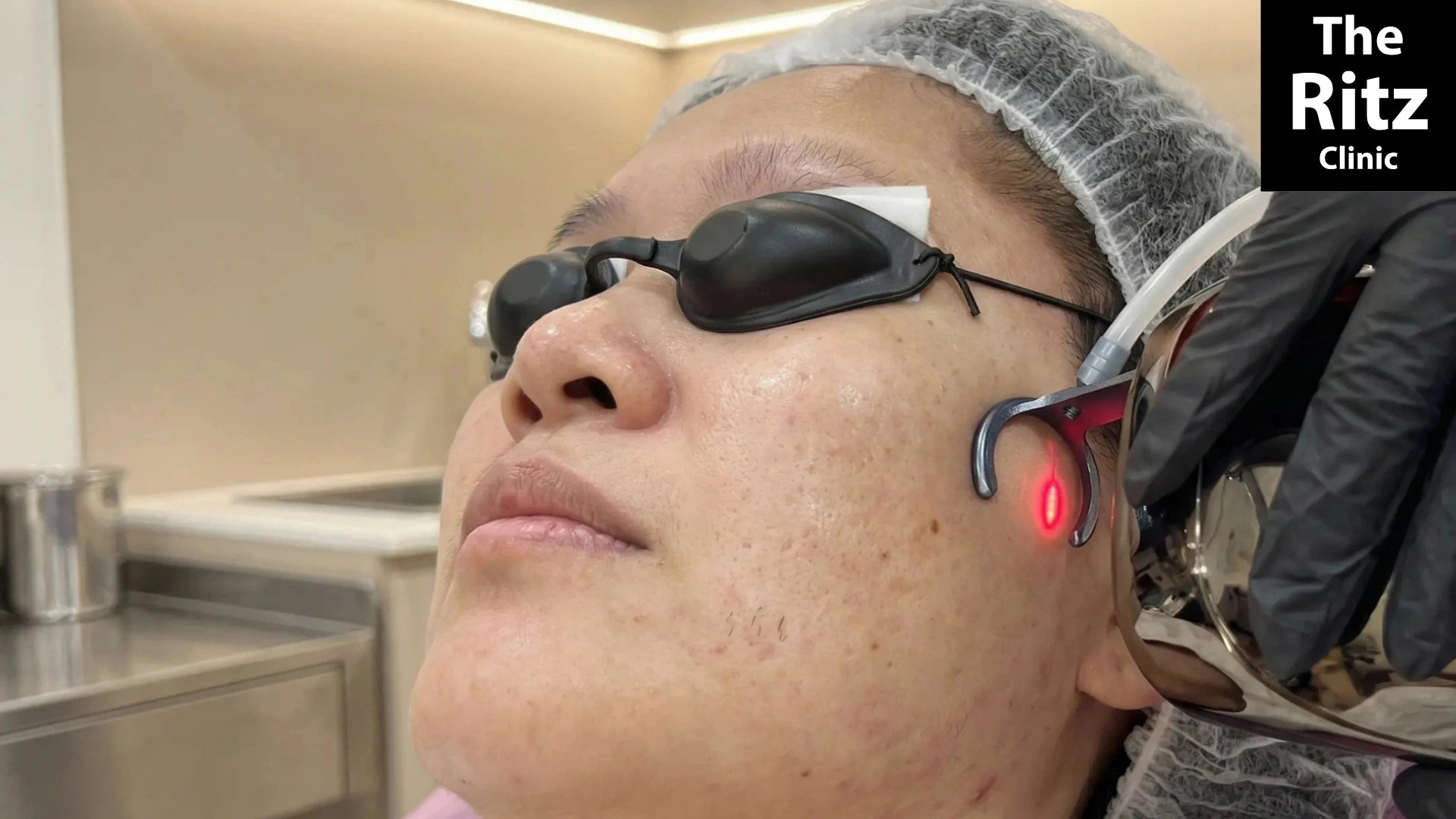 CO2 Laser treatment in Johor Bahru