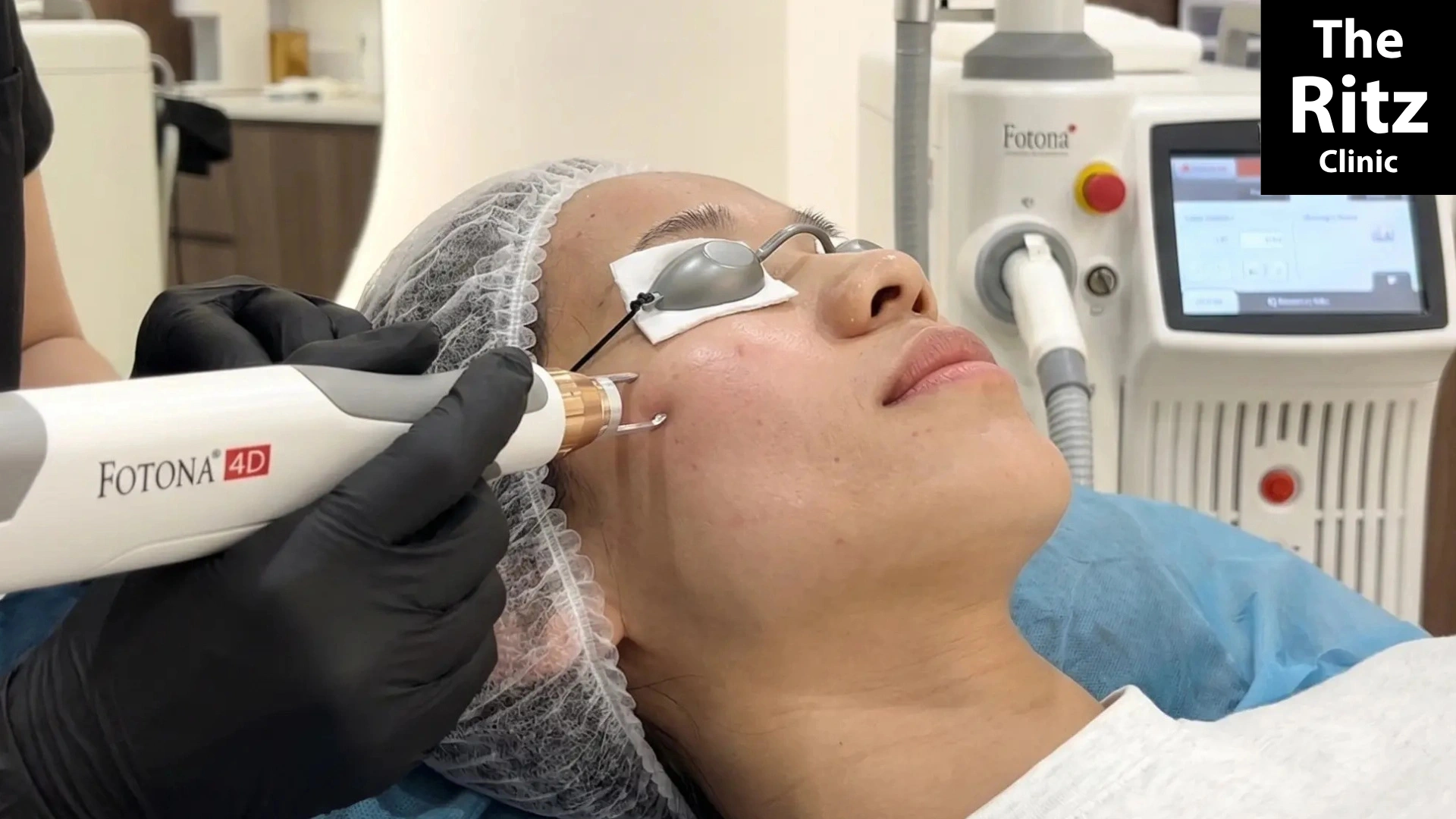 Fotona 4D treatment in Johor Bahru