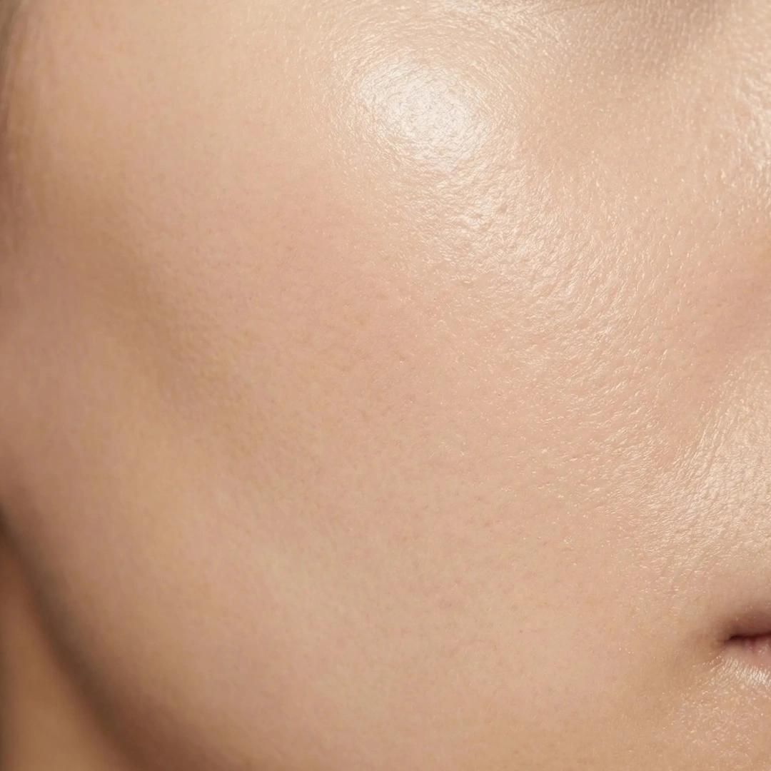 Skin quality improvement with Jalupro