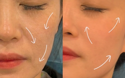 Jalupro before and after skin texture improvement and fine line reduction