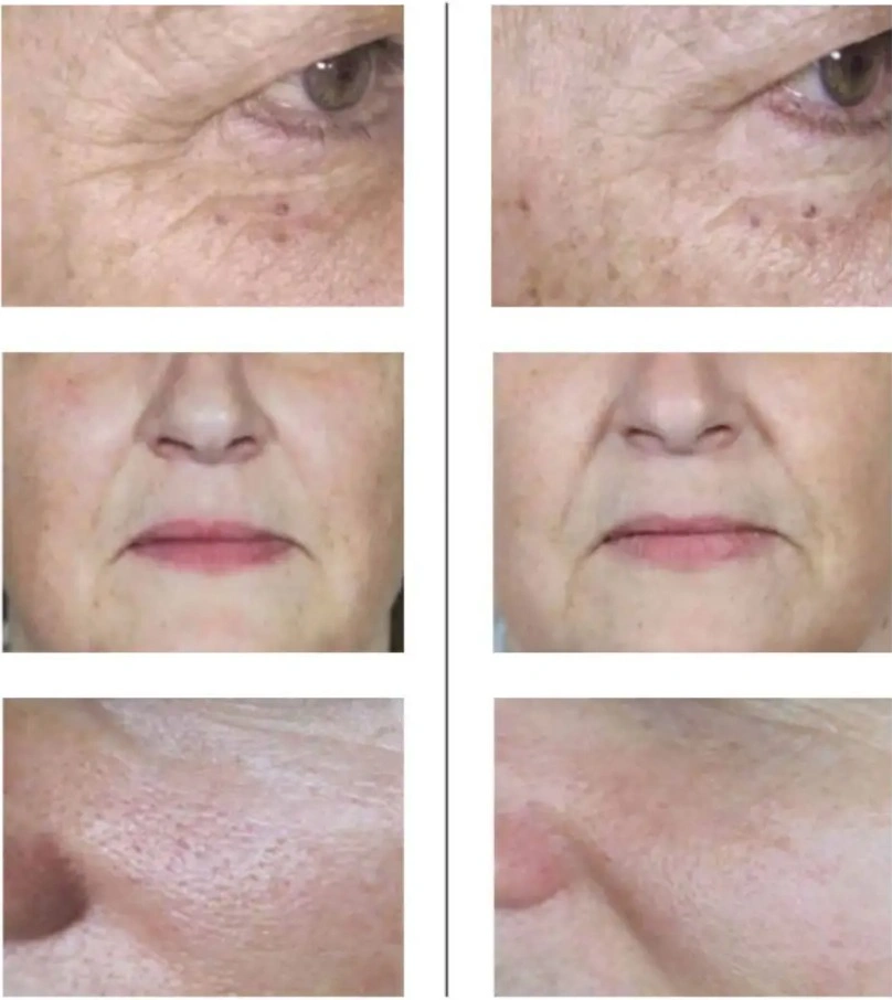 NCTF before and after skin rejuvenation, improved hydration, smoother texture and reduced fine lines