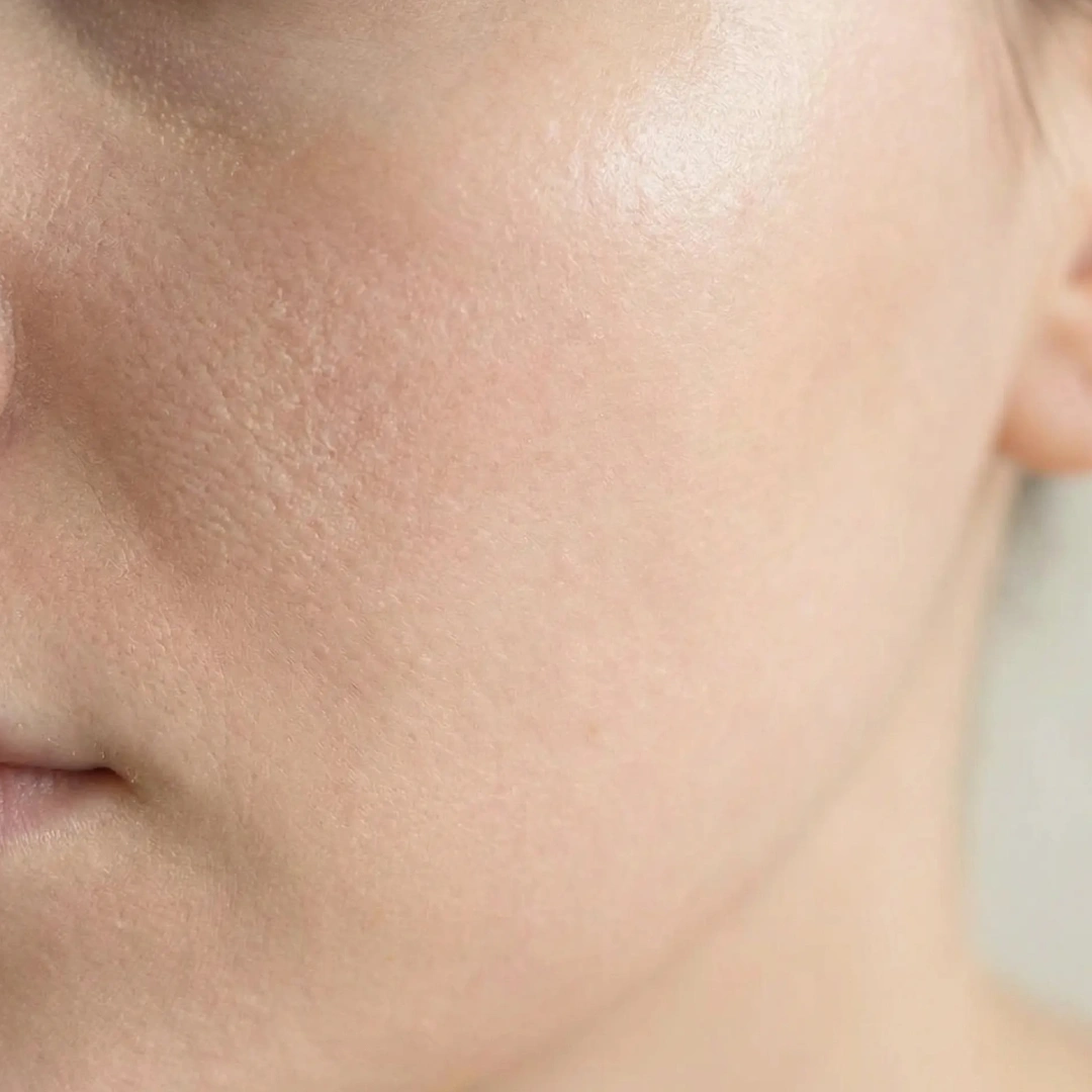 Skin repair support with Plinest