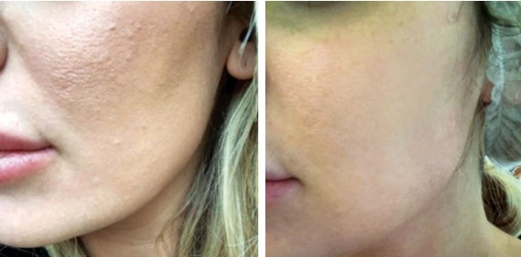 Plinest before and after skin repair, smoother texture and improved skin quality