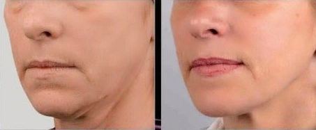 Redensity 1 before and after improved fine lines, smoother skin texture and more youthful appearance