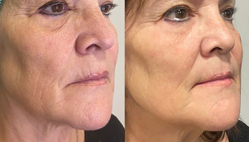 Revoke 50 before and after improved hydration, smoothness and skin radiance