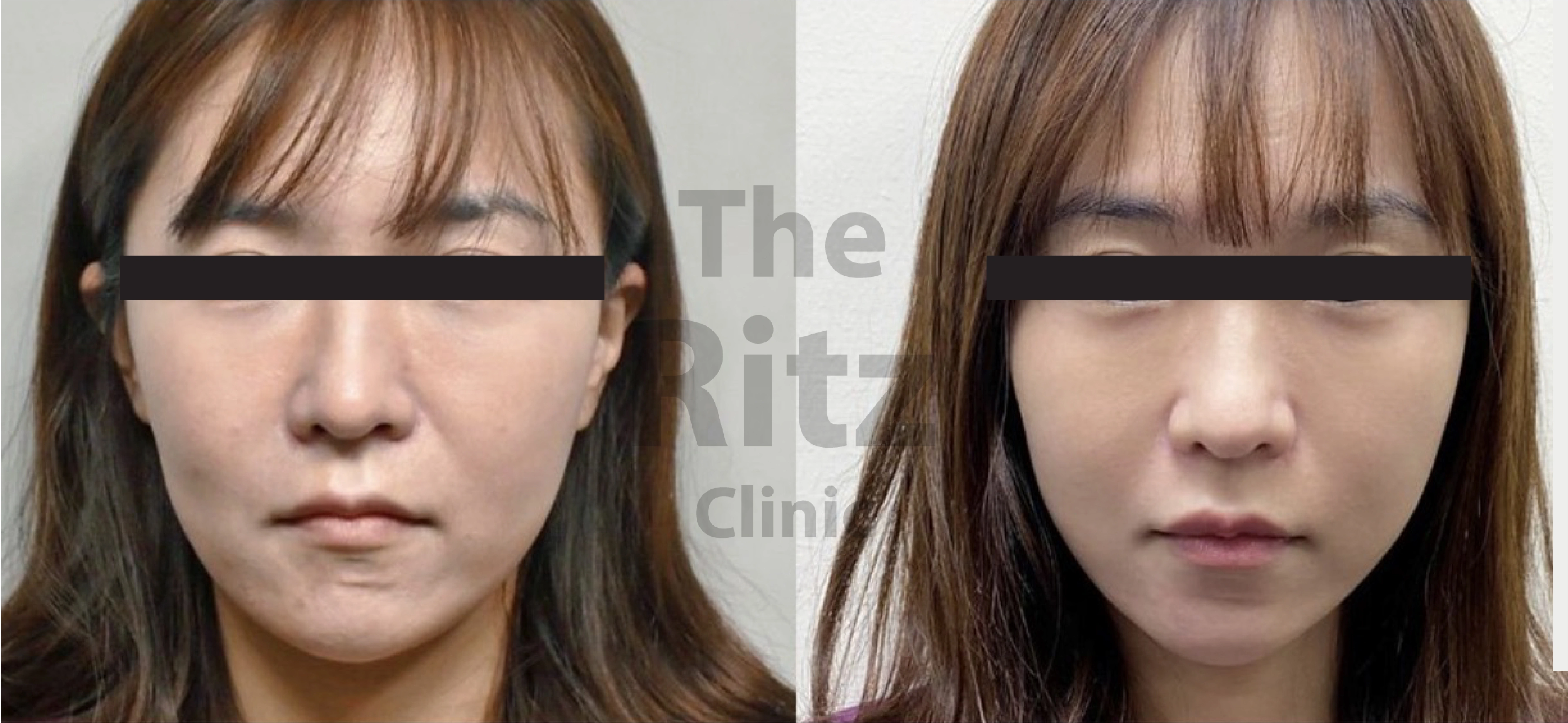 Sculptra before and after facial volume improvement and skin tightening