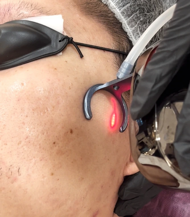 CO2 Laser treatment