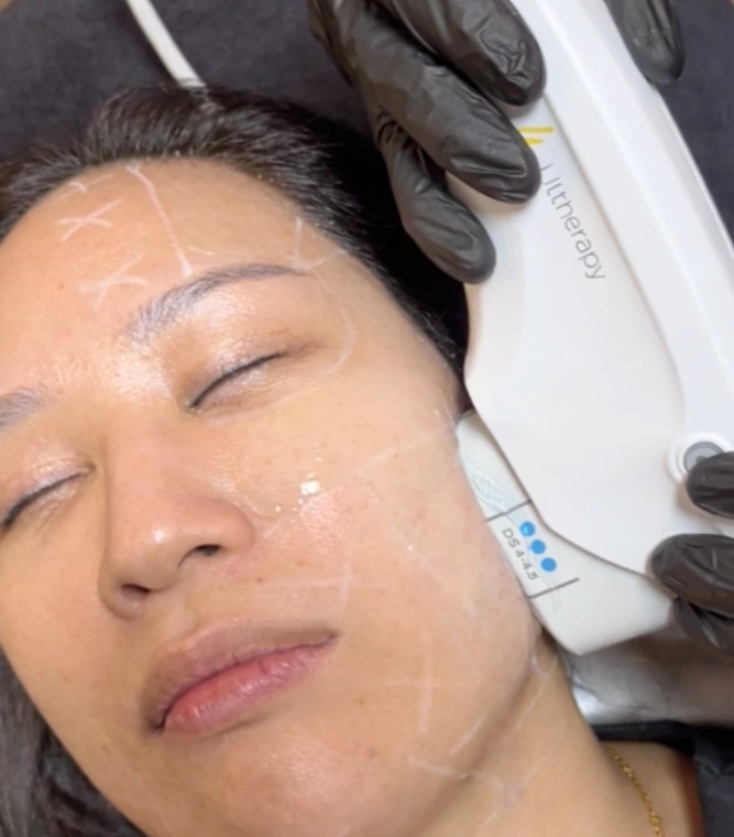 Ulthera treatment