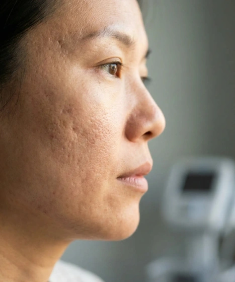 Acne and acne scar skin concern assessment at The Ritz Clinic in Johor Bahru Malaysia