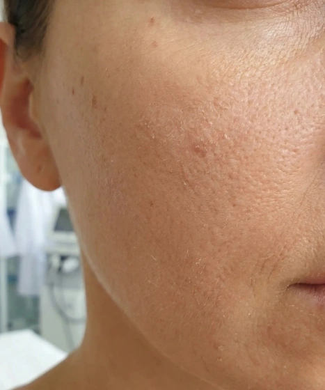 Dry and dehydrated skin assessment at The Ritz Clinic in Johor Bahru Malaysia