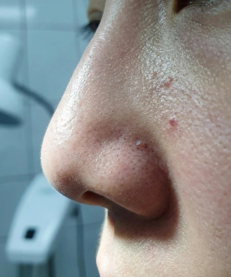 Enlarged pores and skin texture assessment at The Ritz Clinic in Johor Bahru Malaysia