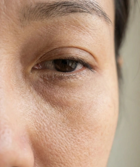 Eye bags and dark eye circles assessment at The Ritz Clinic in Johor Bahru Malaysia