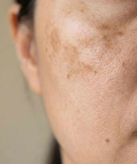 Skin pigmentation assessment and treatment at The Ritz Clinic in Johor Bahru Malaysia
