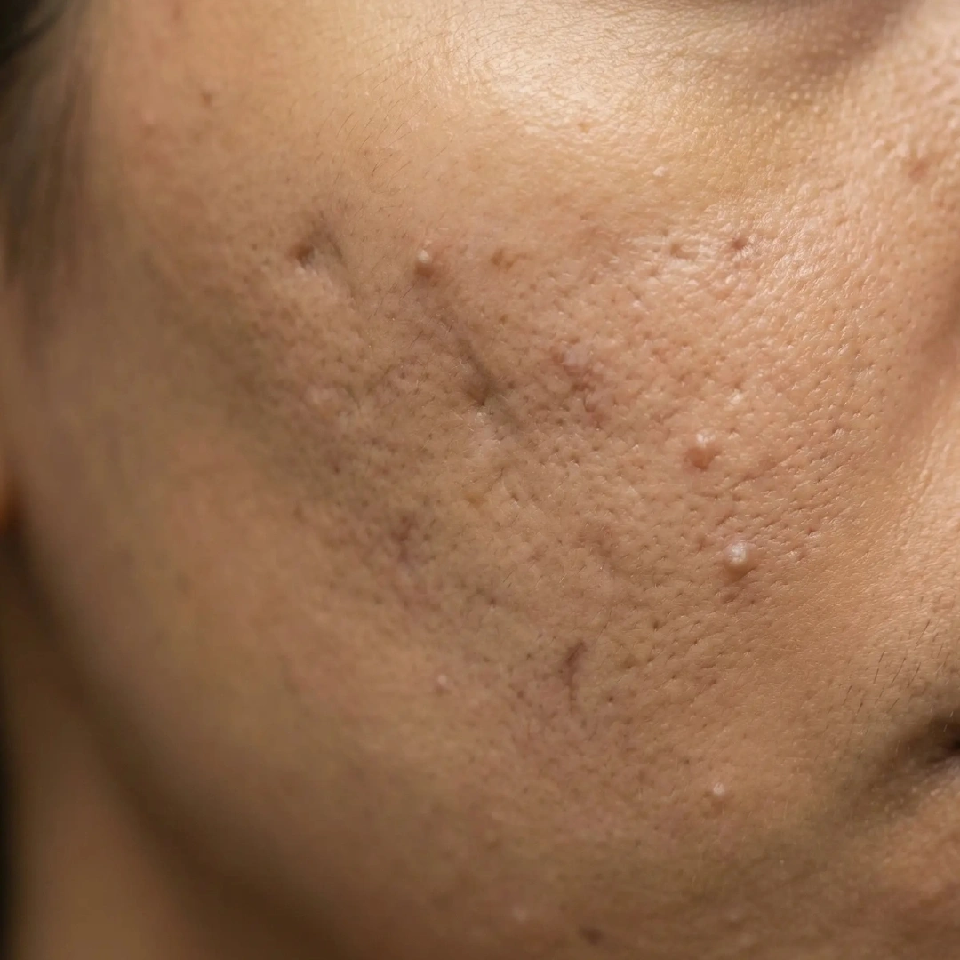 Acne scar revision