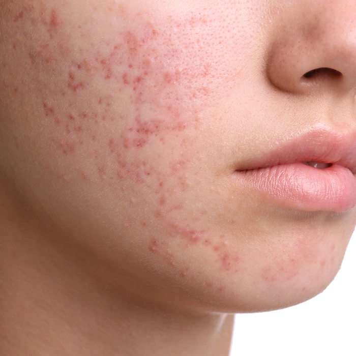 Acne Skin Concern