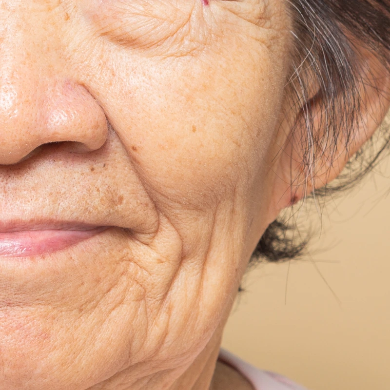 Ageing skin concern