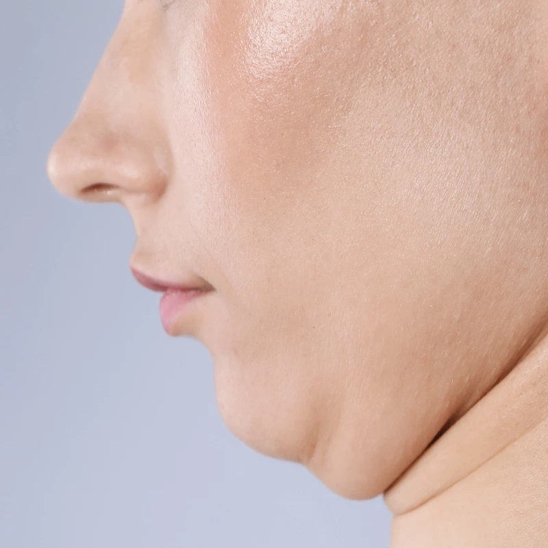 Double chin concern