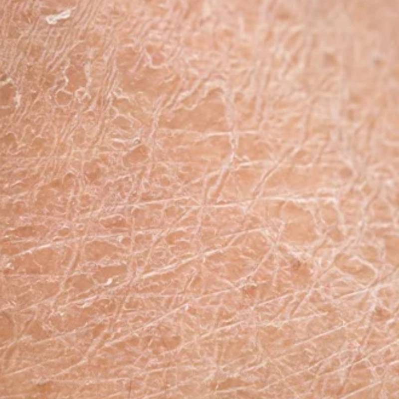 Dehydrated skin concern