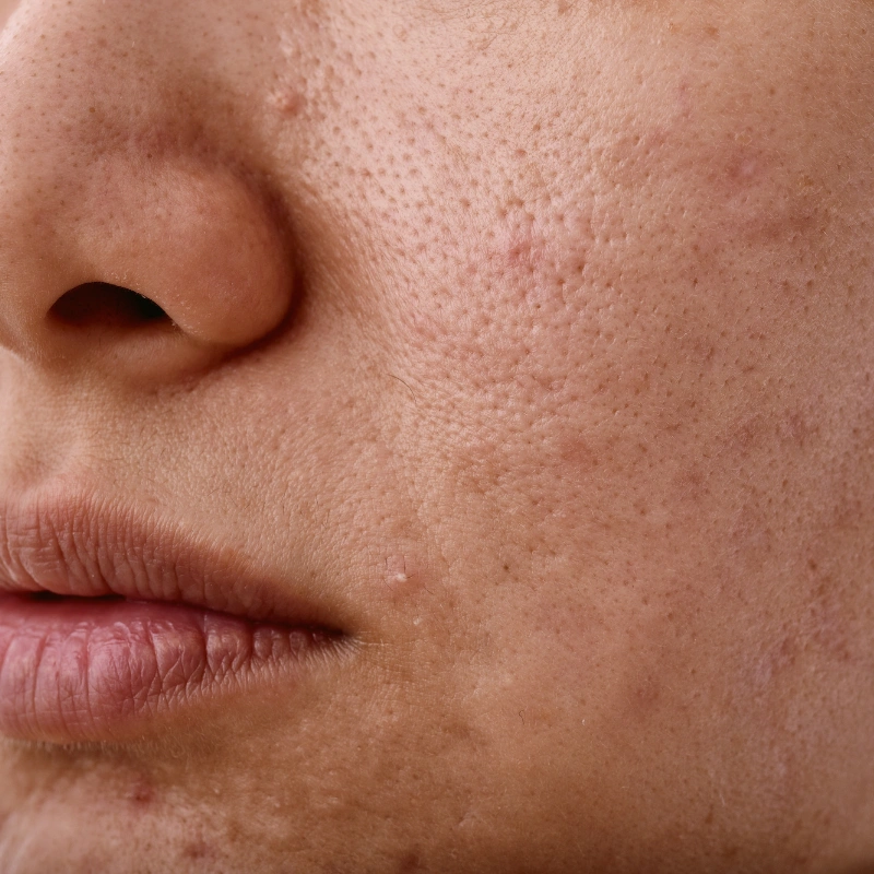 Dull skin concern
