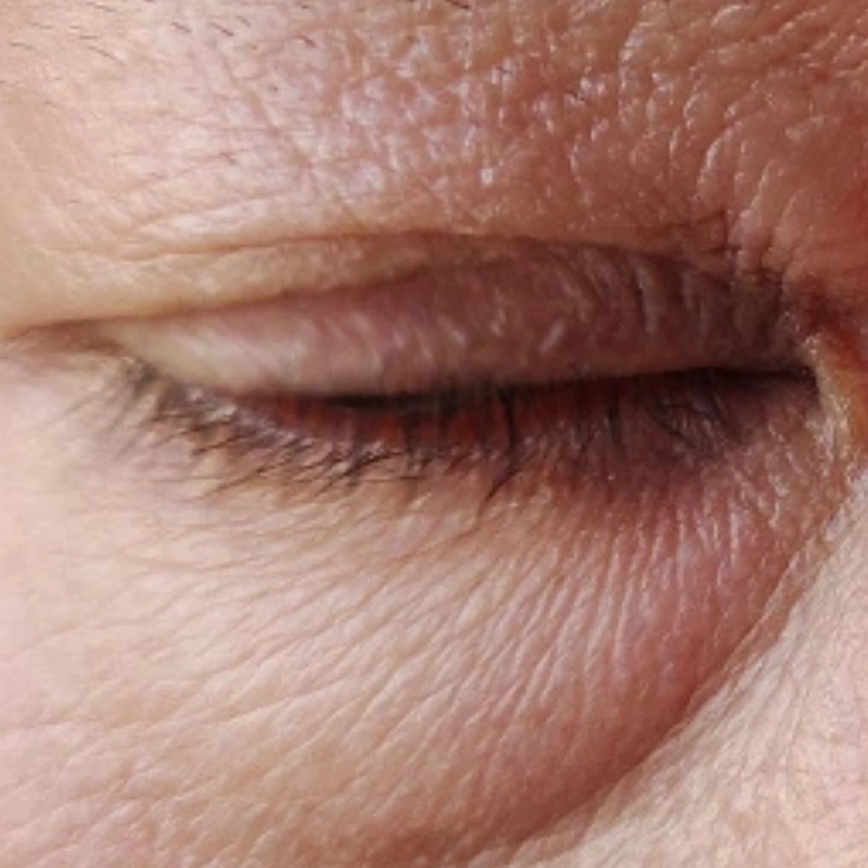Under-eye skin concern