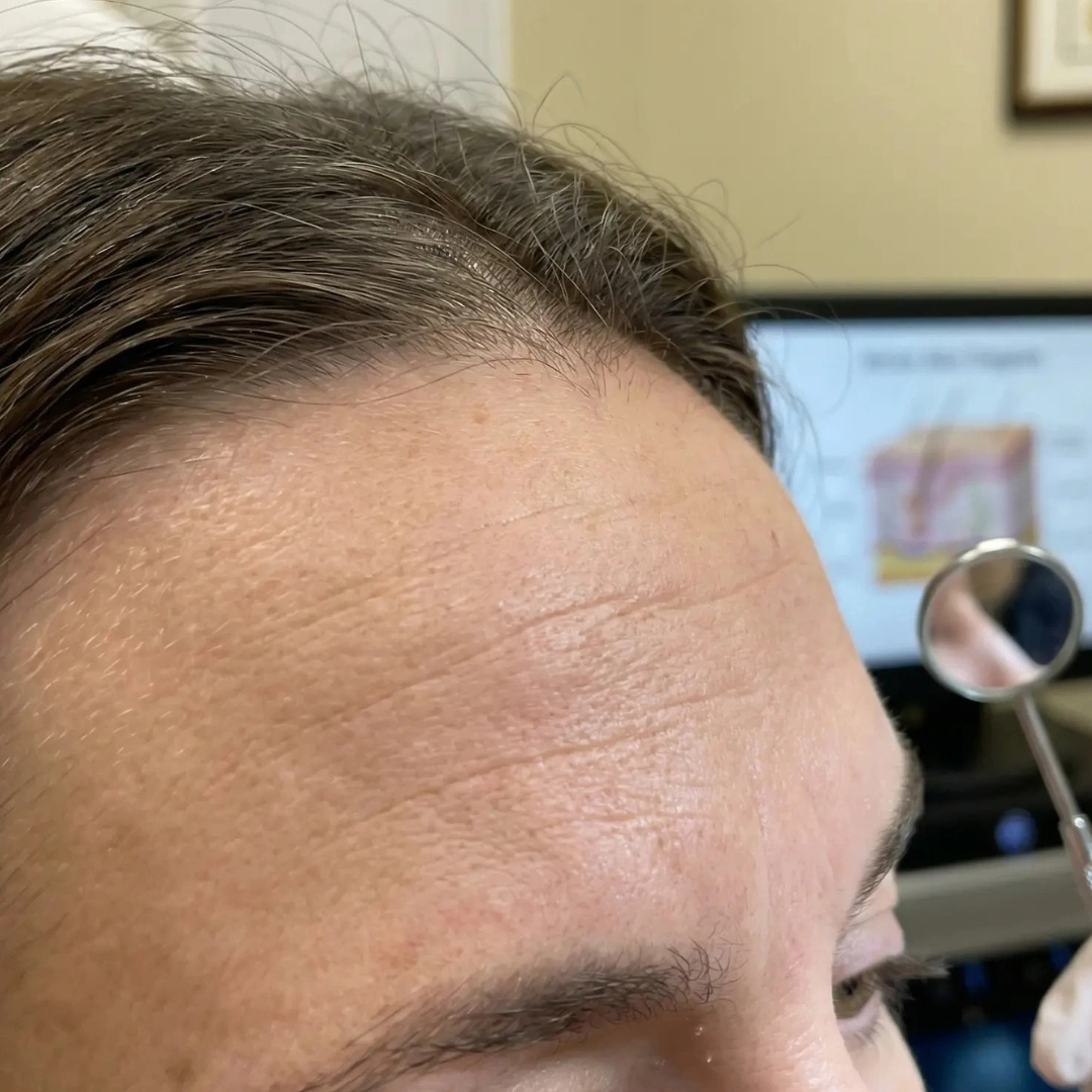 Forehead Lines Concern
