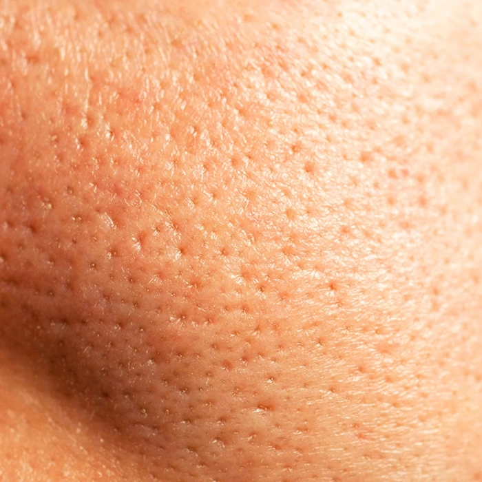 Large Pores Skin Concern