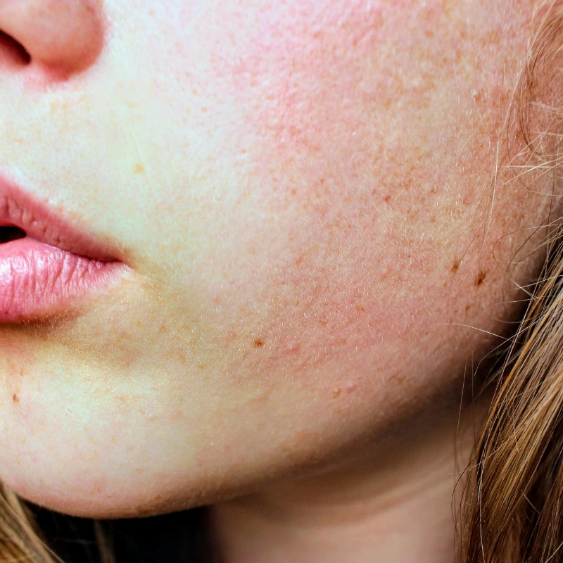 Redness and rosacea-prone skin concern