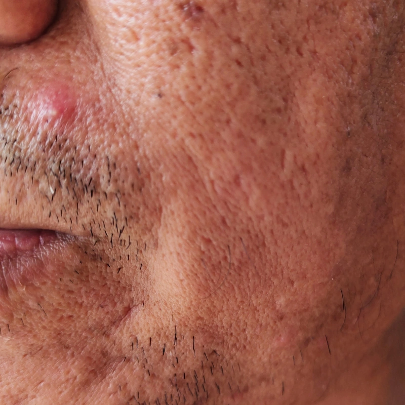Rough skin texture concern