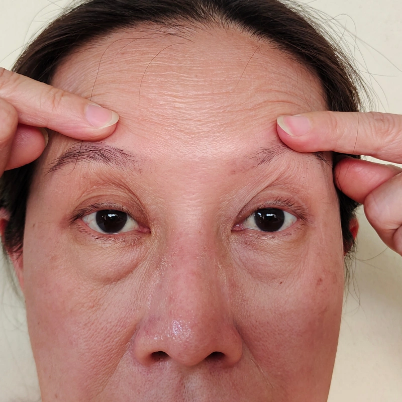 Skin laxity concern