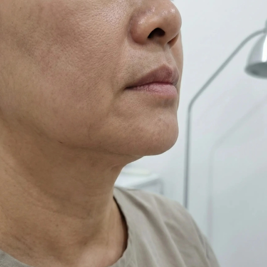 Jawline Definition Skin Concern