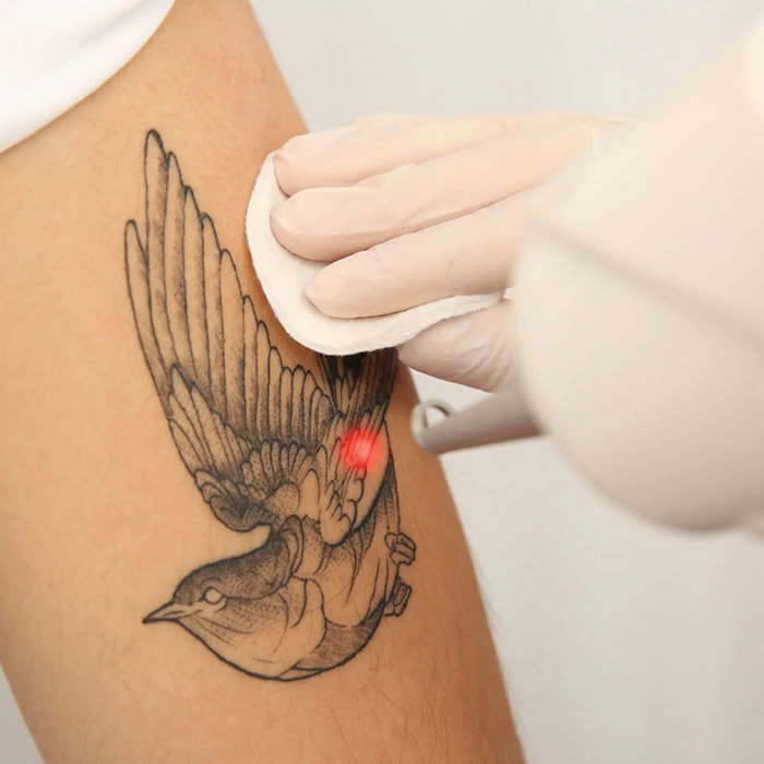 Tattoo Removal