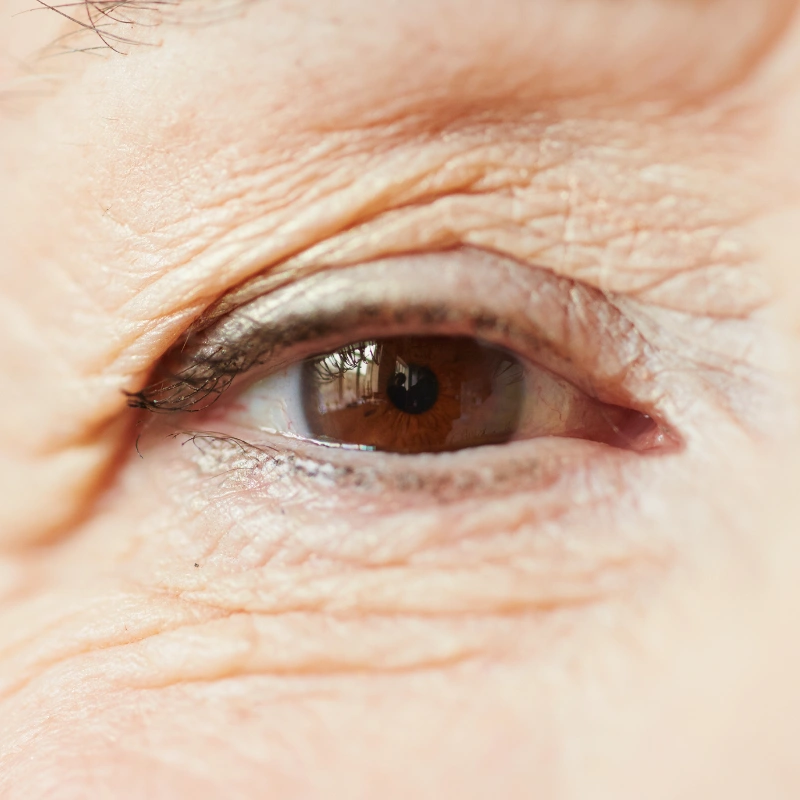 Under-eye skin concern