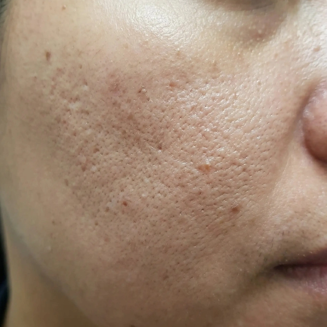 Uneven texture concern