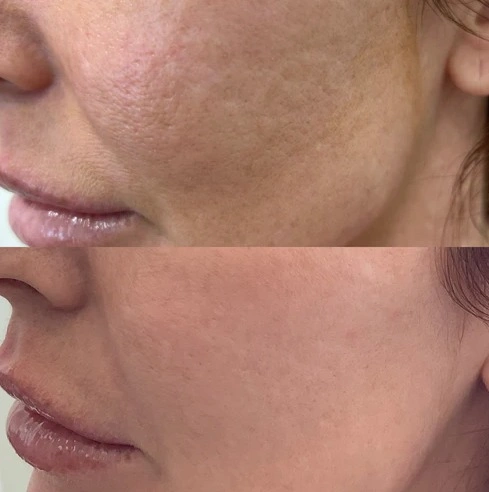 SKINVIVE before and after smoother cheek skin and hydration improvement