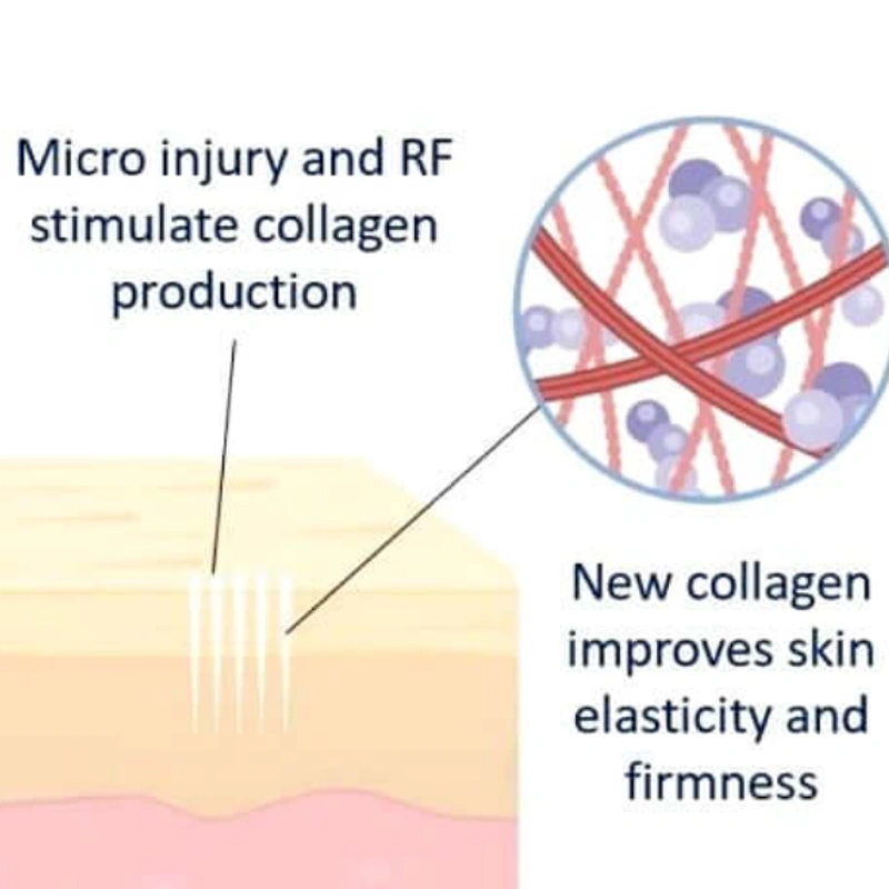 Collagen remodelling with Sylfirm X