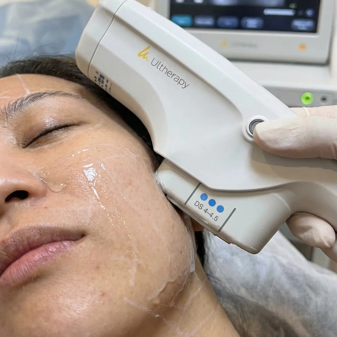 Ultherapy Prime real-time targeting