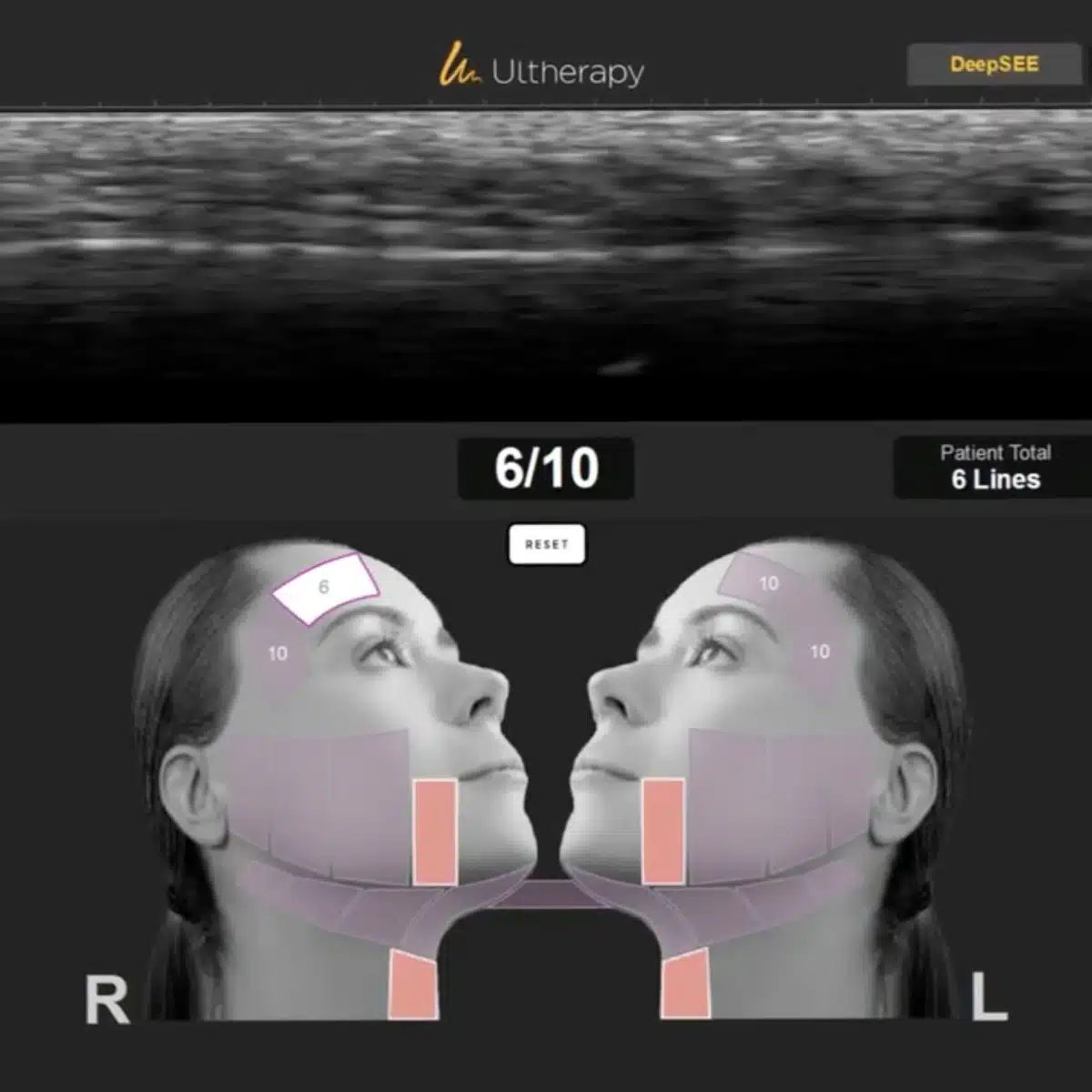 Ultherapy Prime focused energy and real-time visualisation