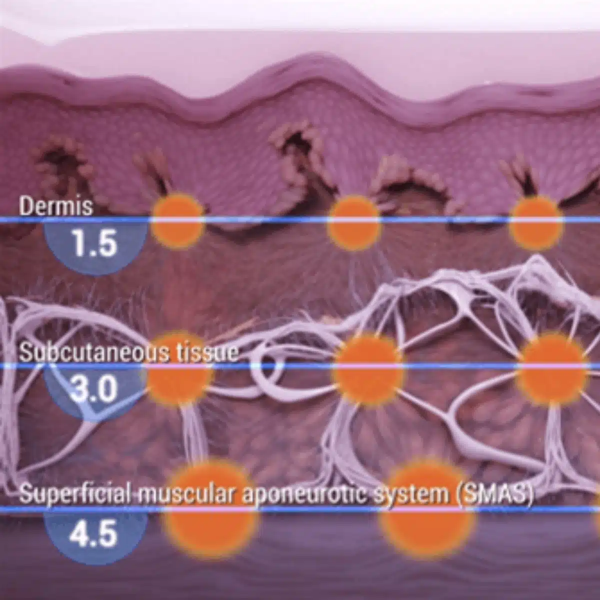 Gradual natural-looking Ultherapy Prime lifting results