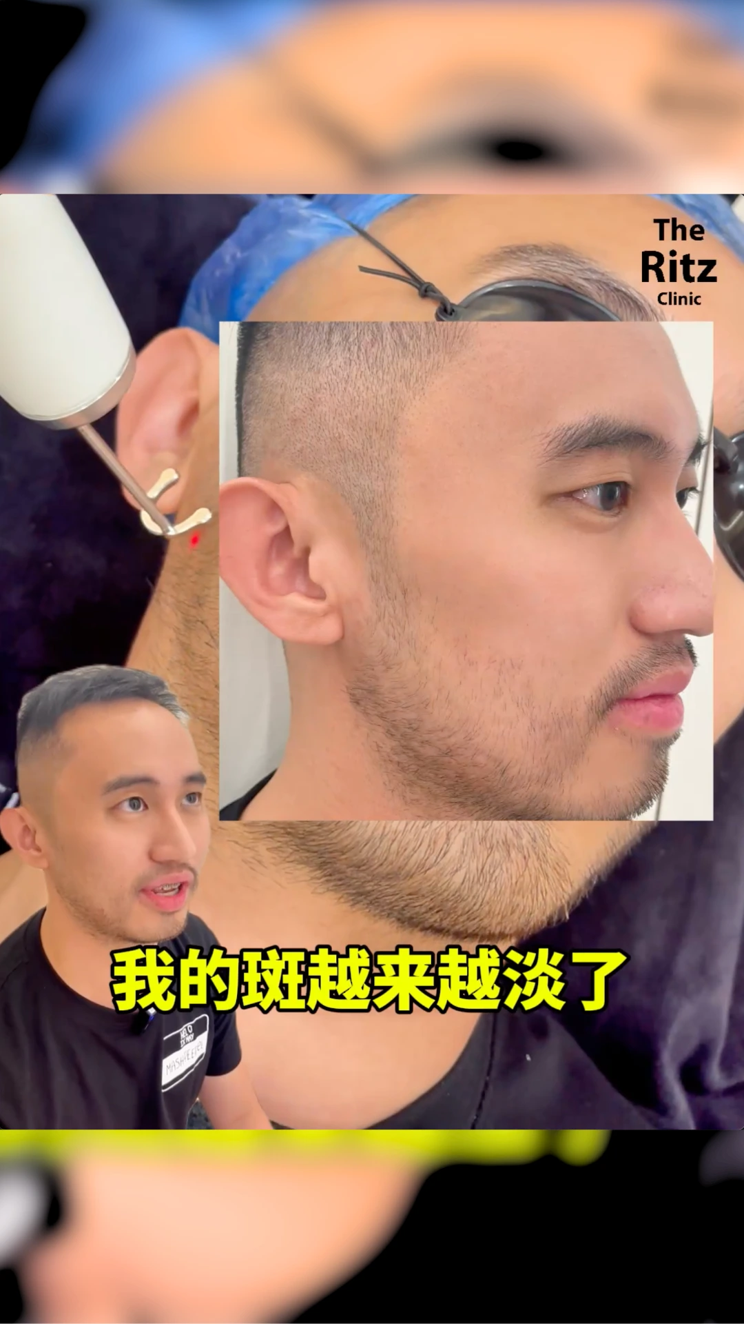 Pico Laser Testimonial